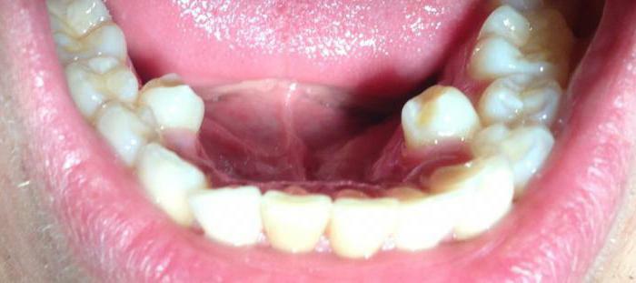 hammas ylikypsää