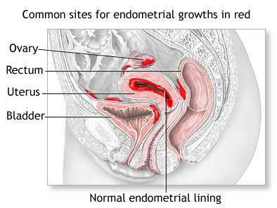 primárna oligomenorrhea