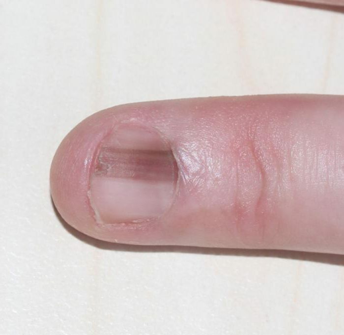 Melanoma under the fingernail