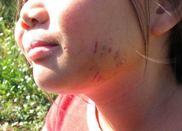 What to do if a child is bitten by a dog or scratched