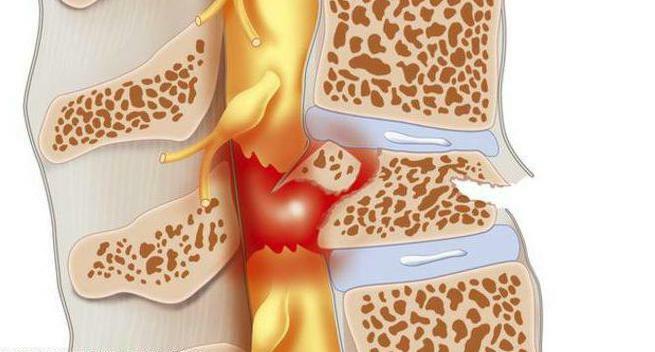 back disease osteochondrosis