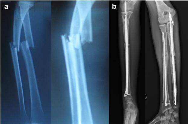 ulna og radius