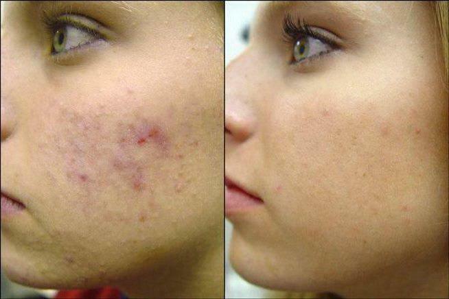 dermatrix for correction of scars