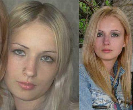 Valery Lukyanov before and after surgery