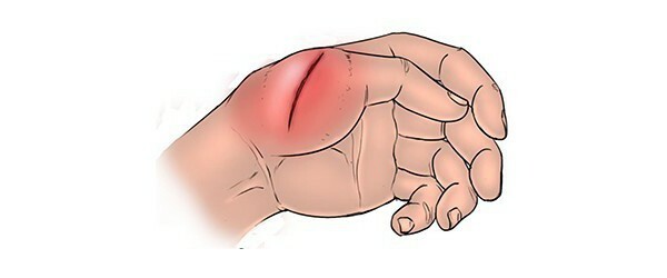 Koloto-cut wound: its characteristics and first aid