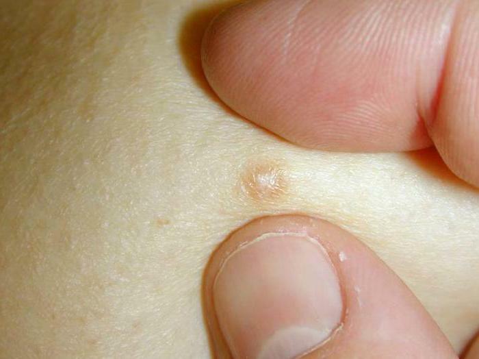 removal of dermatofibroma