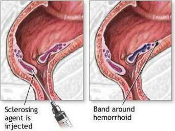 types of hemorrhoids and its treatment