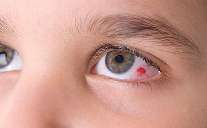 how much time is treated with adenoviral conjunctivitis