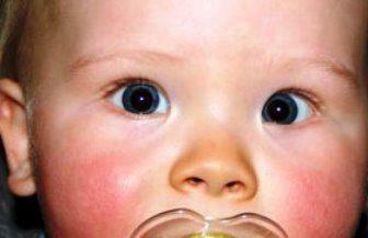 causes of strabismus