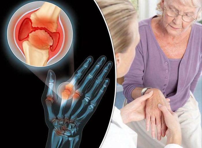osteoarthritis diagnosis