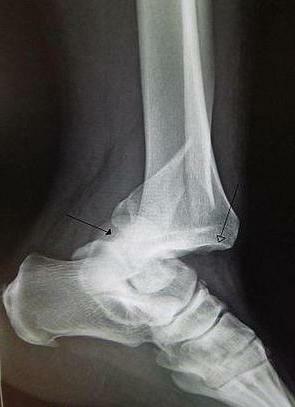 Post-traumatic arthrosis of the ankle joint