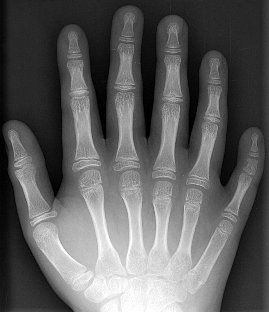 Karyotype of a patient with Patau