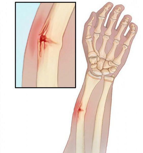 open fracture of forearm