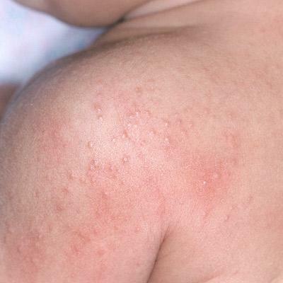 small pimples on the body itch