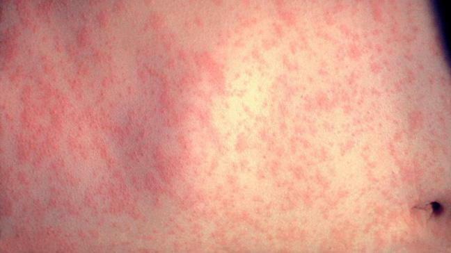how is rubella transmitted in adults
