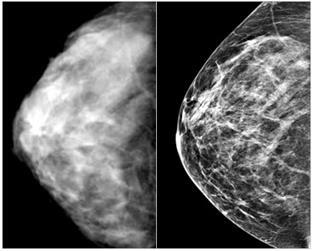 mammography or uzi