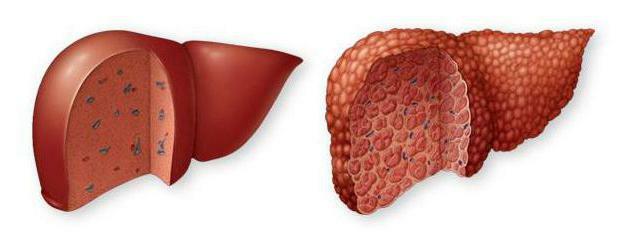 nonalcoholic fatty liver disease recommendations