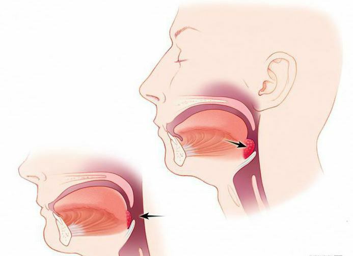 perioada postoperatorie a amigdalectomiei