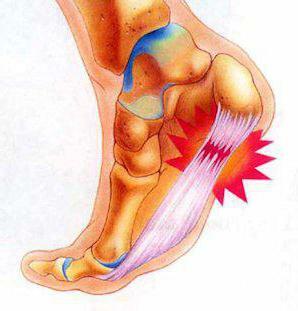 bolesť v päte medzi pätou a špičkou pri chôdzi