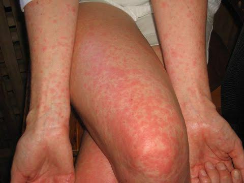 durch wie viel der Hautausschlag von Allergien ist