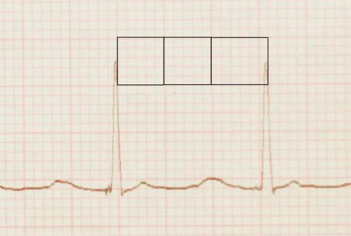 EKG Konklusion