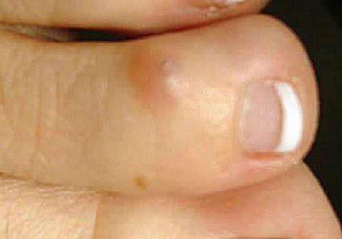 how to treat dry toe on the toe