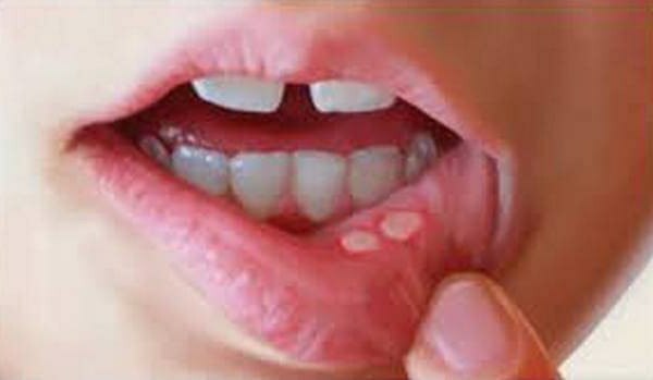 bacterial stomatitis in children treatment