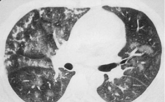 idiopathic hemosiderosis of the lungs