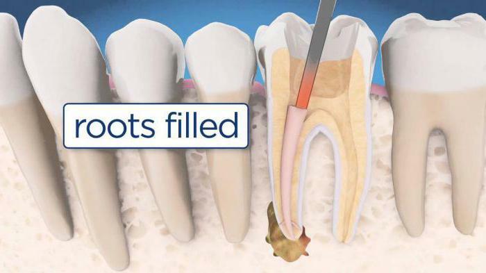 Filling materials for root canal filling