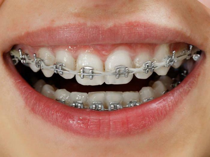 is it painful to put braces reviews