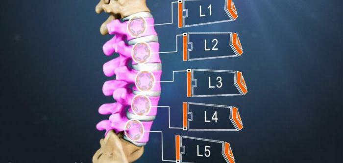 antelisthesis l5 vertebra what is it