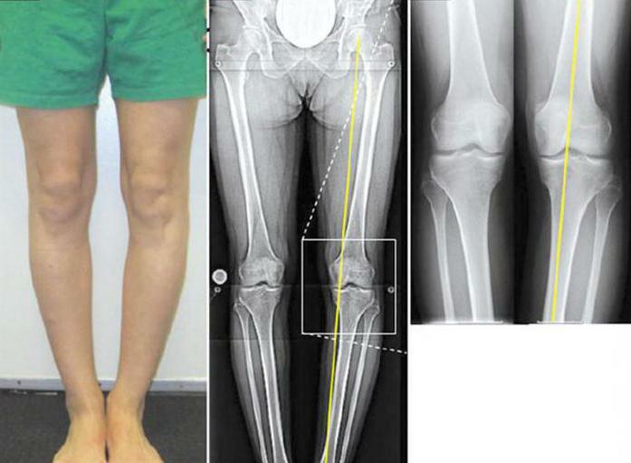 Valgusová deformita kolenných kĺbov u detí