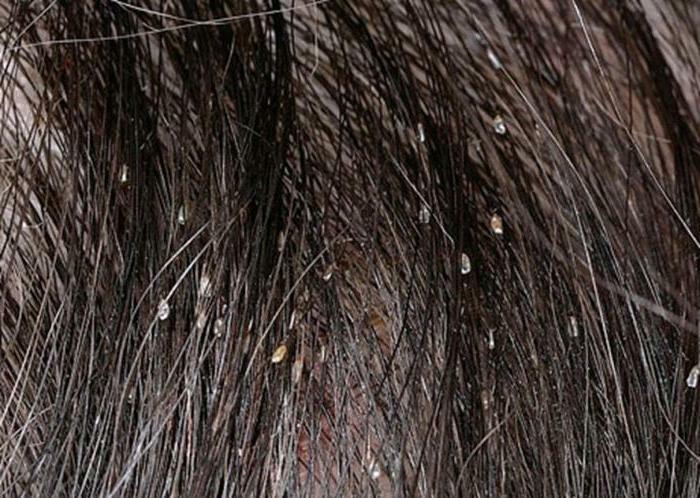 How to distinguish nits from dandruff: expert advice