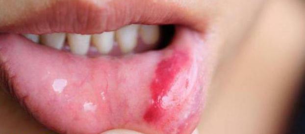 Is stomatitis contagious or not?