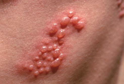 herpes zoster treatment in adults