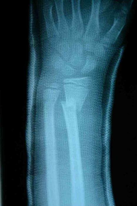 fracture of forearm bones