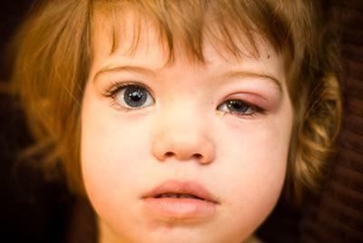 Barley on the eye causes treatment