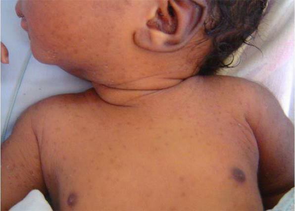 vesiculopustulosis in newborns
