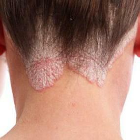 shampoo for psoriasis on the head