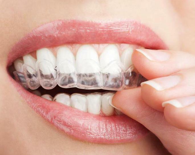 what are the braces reviews and prices