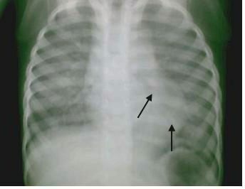 idiopathic hemosiderosis of the lungs