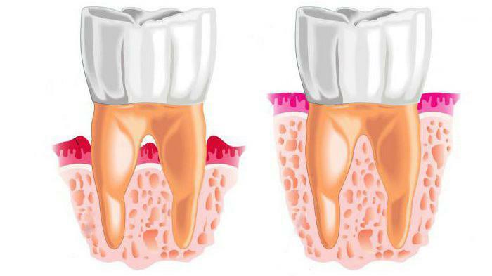 prevention of periodontal disease
