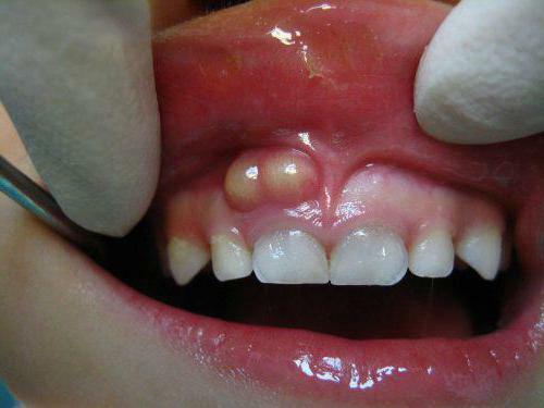 the baby on the gums has a gnawing what to do