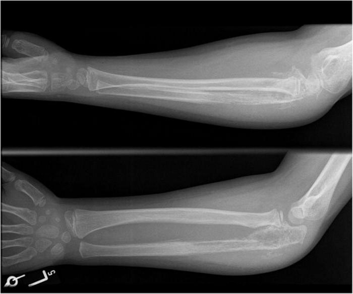 ulnar proces af ulna