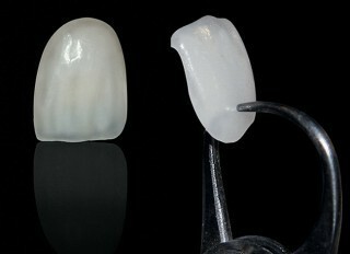 Ceramic crown on tooth photo