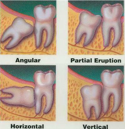 wisdom tooth why so named
