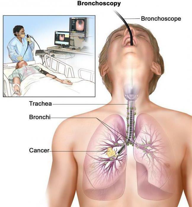 treatment of squamous cell lung cancer