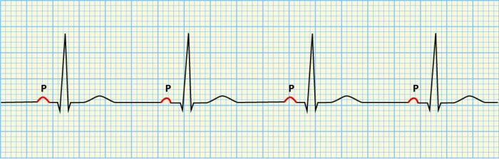 short pq syndrome