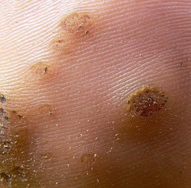 how to get rid of hanging warts