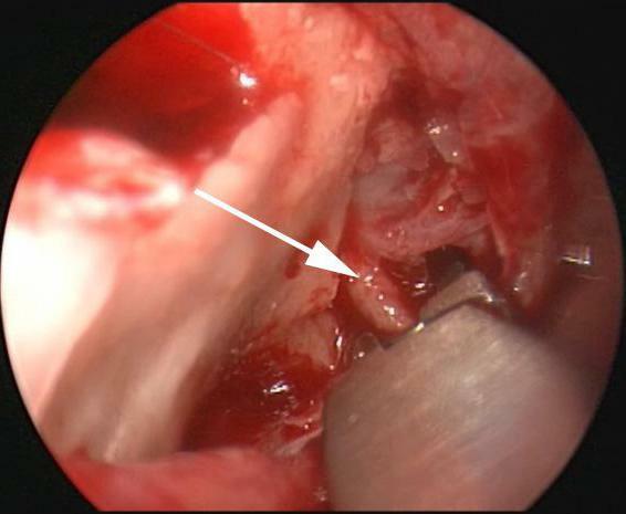 signs of capillary bleeding from the nose